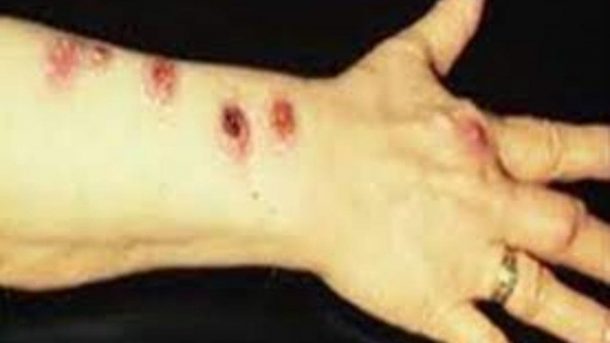 disease